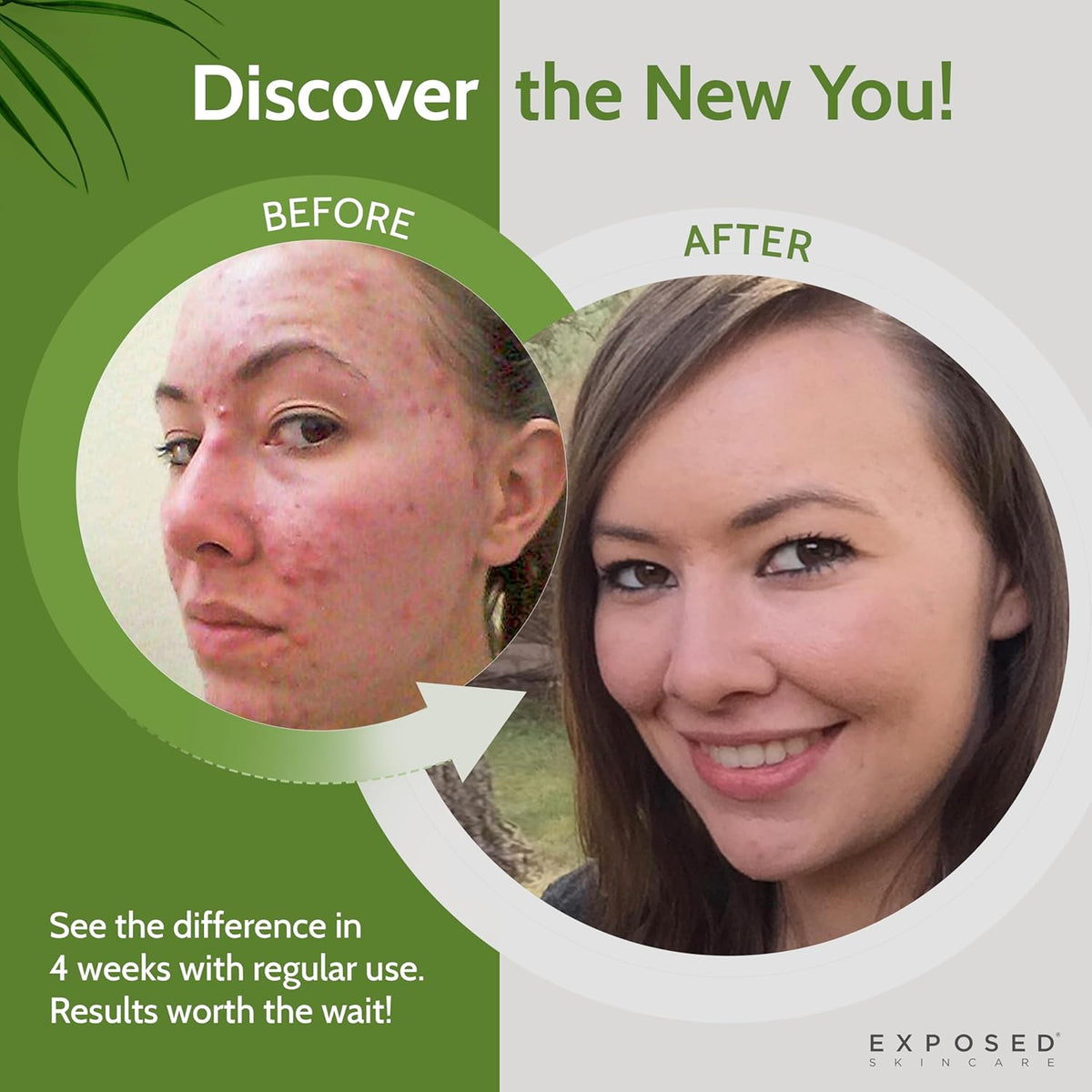 Exposed Skin Care Clearing Tonic Facial Toner with 1% Salicylic Acid and Witch Hazel for Acne