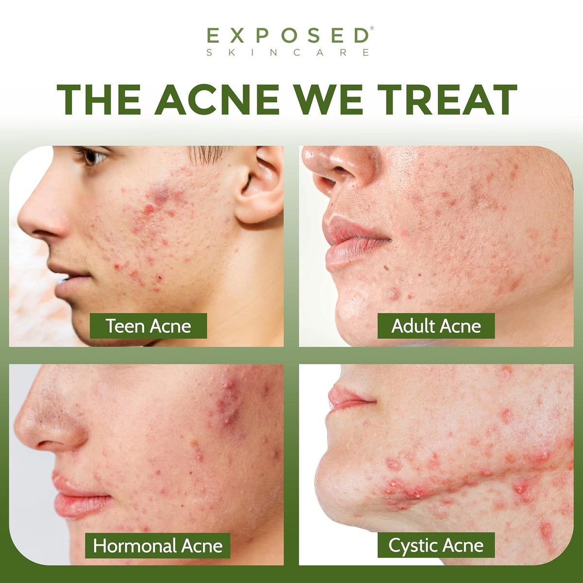 Exposed Skin Care Clearing Tonic Facial Toner with 1% Salicylic Acid and Witch Hazel for Acne