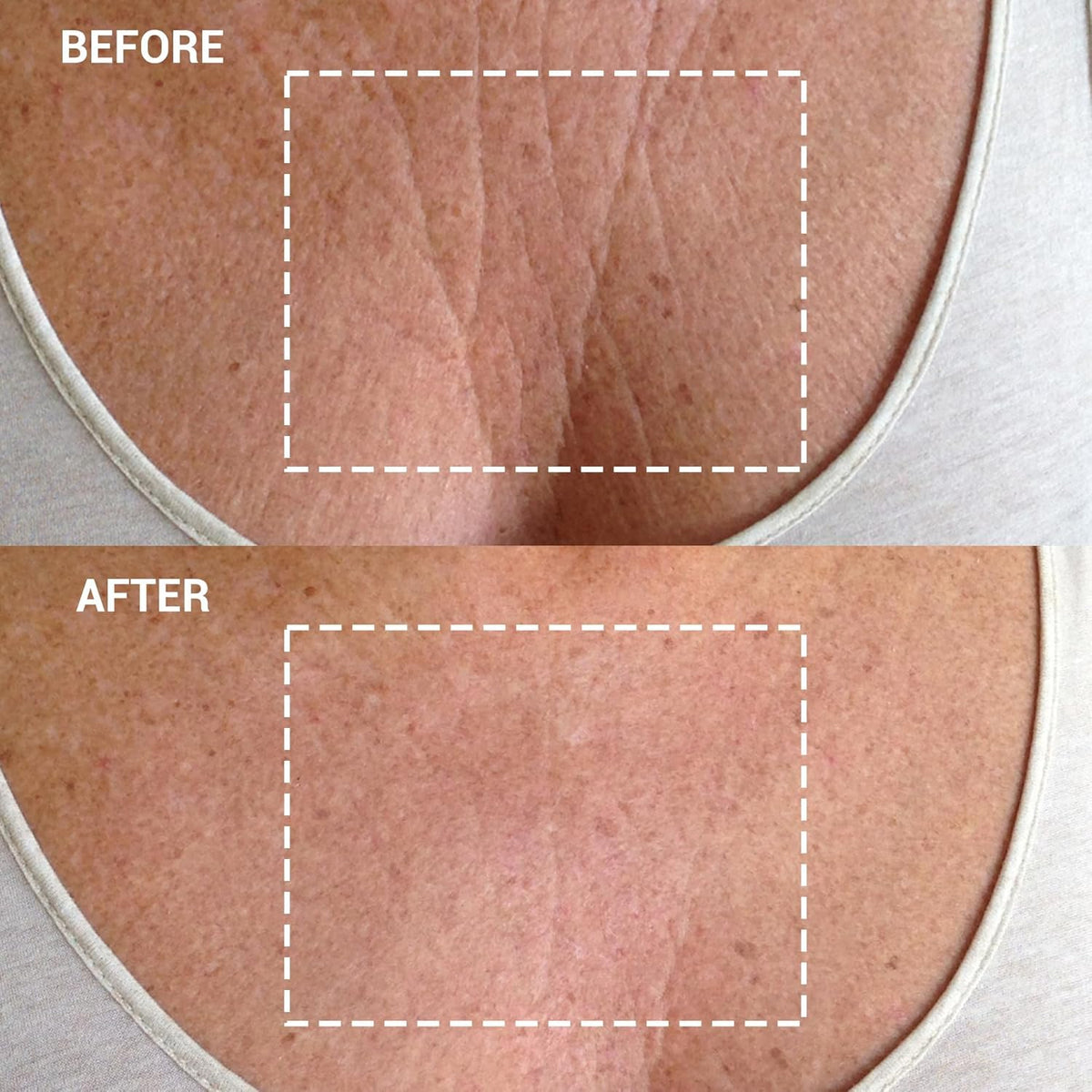 Wrinkles Schminkles Chest Wrinkle Patch & Cleanser Starter Pack - Set of Reusable Chest Silicone
