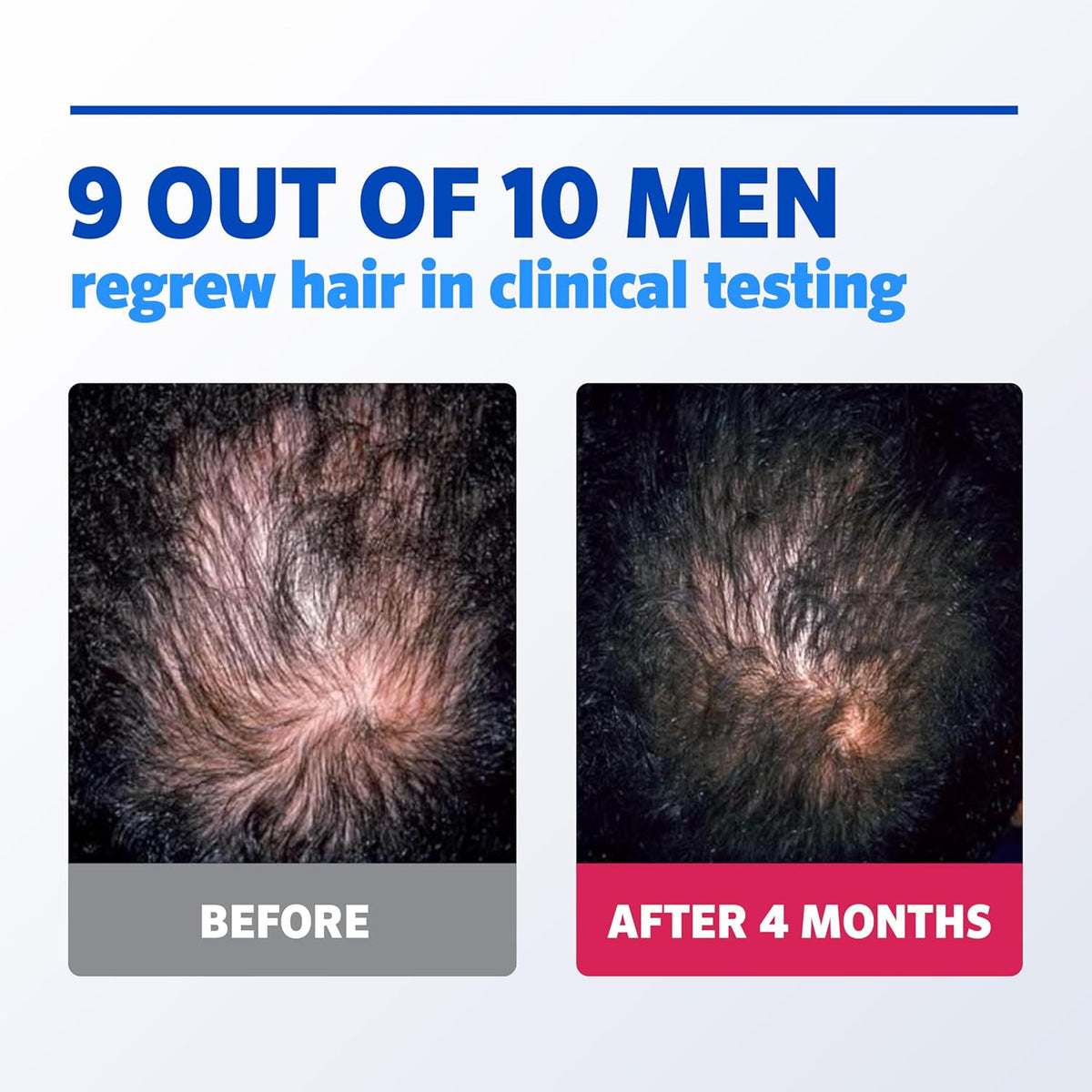 Men’s Rogaine 5% Minoxidil for Men Foam, Clinically Proven Regrowth for Thinning Hair, Topical Hair