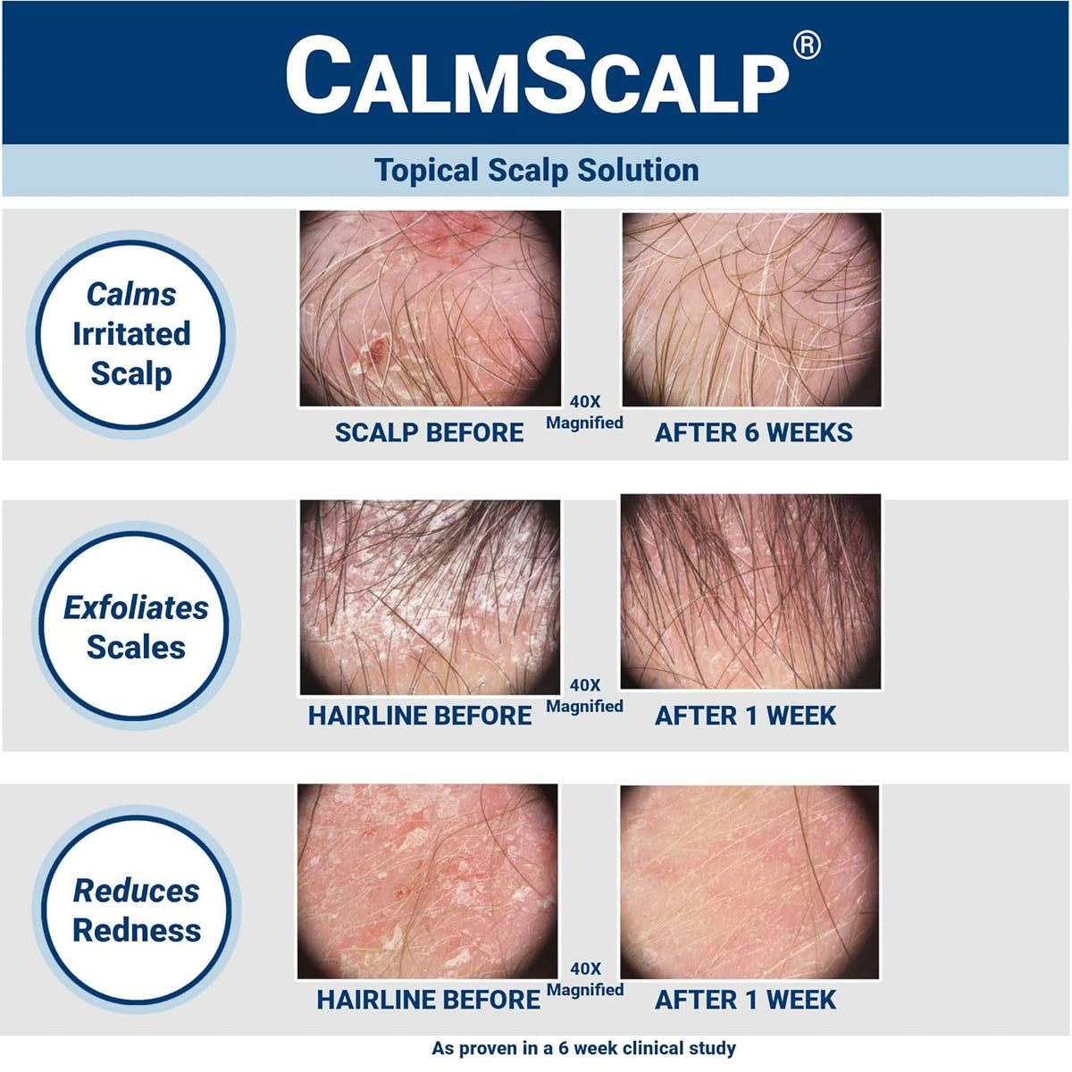 Scalp Serum | Scalp Itch Relief | Scalp Treatment | Exfoliates Scales and Flakes | Clinically