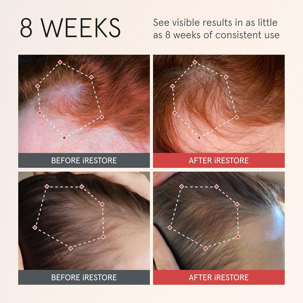 iRESTORE Scalp Serum | Hair Growth Serum for Women Men | Best for Hair Loss Hair Thinning | Aids