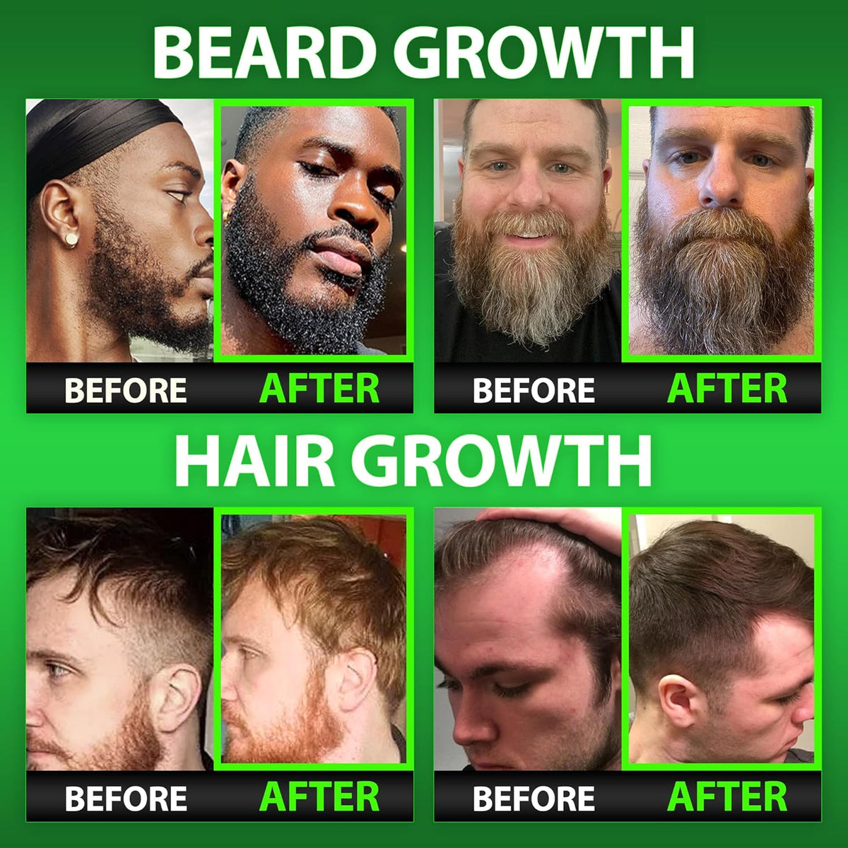 Beard Growth Kit w/GROW Beard Oil for Men (Mens Beard Growth Serum) + Biotin Gummies Beard Growth