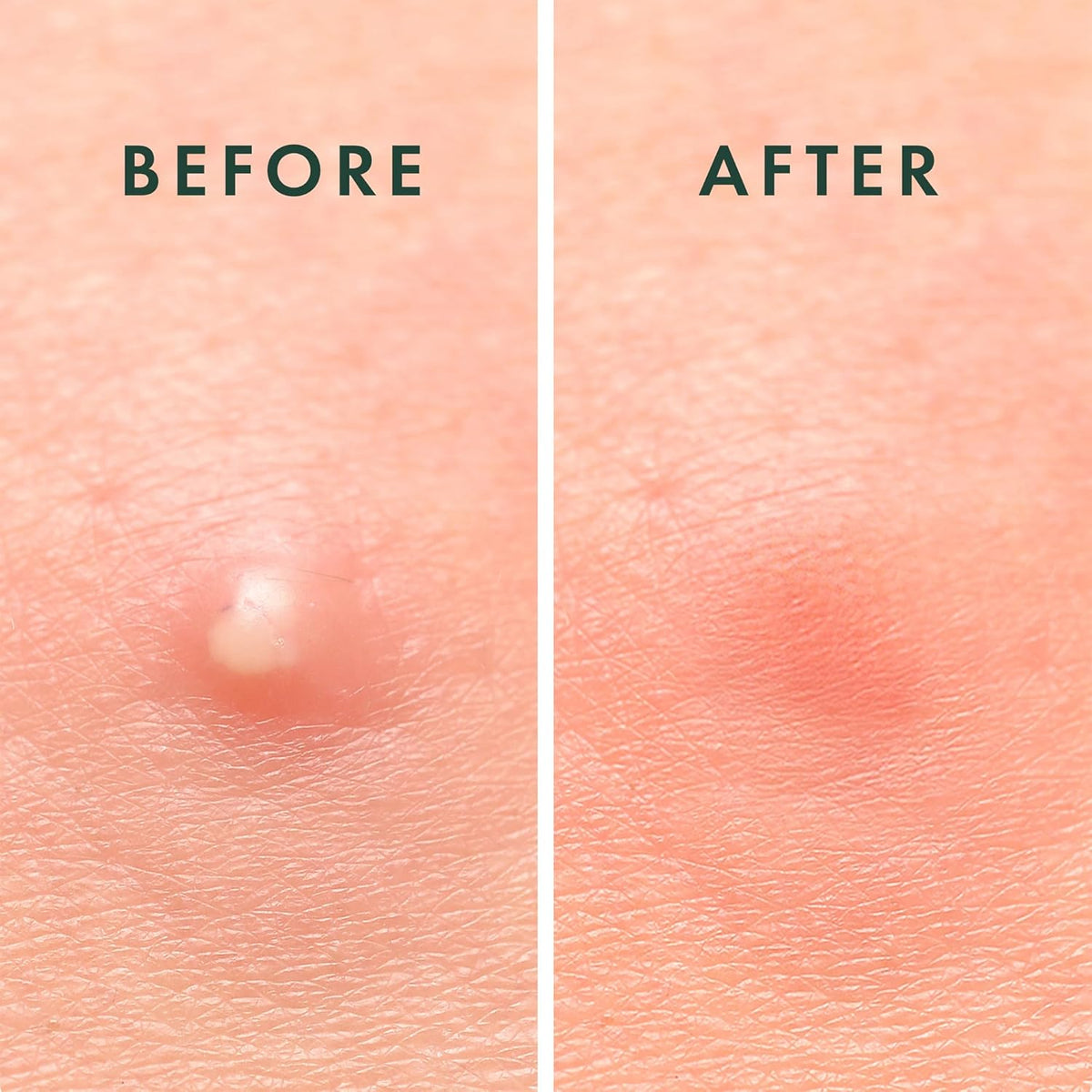 Rael Pimple Patches, Miracle Invisible Spot Cover - Hydrocolloid Acne Patch, Treatment for
