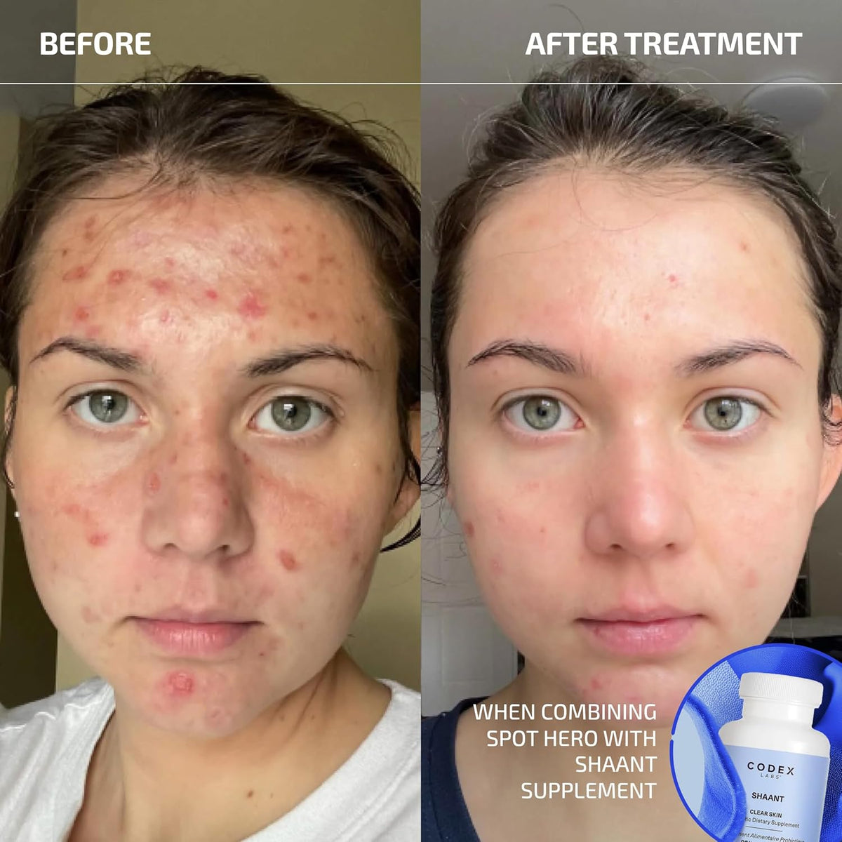 Codex Labs Shaant Spot Hero – Sulfur & Green Tea Gel for Blemish-Prone Skin | Fast-Drying Formula