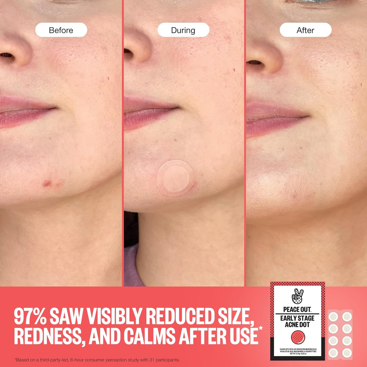 PEACE OUT Early Stage Acne Dots Helps Target Blemishes Below the Surface, Hydrocolloid Pimple