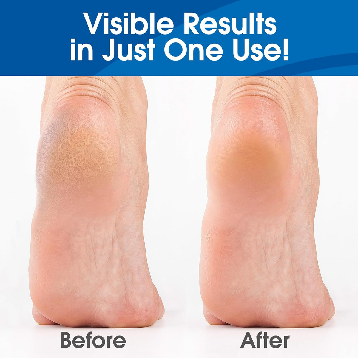 DeEnti Callus Remover for Feet, Extra Strength Foot Callus Remover Gel, 8oz Salon Grade Home