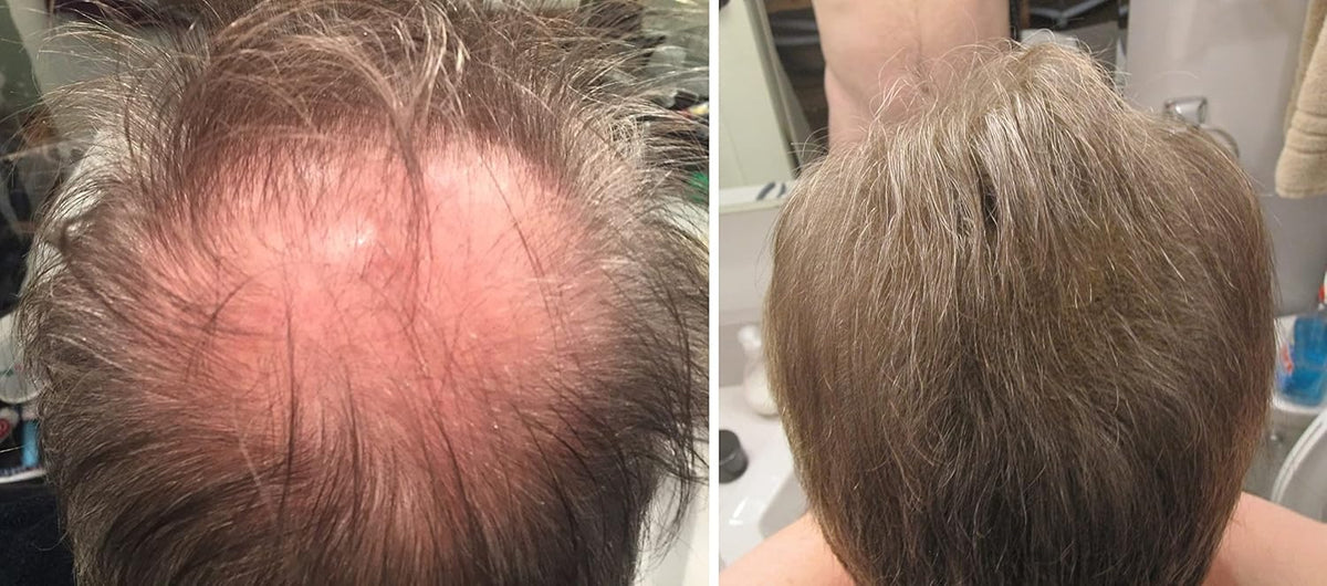 Caboki All-Natural Hair Building Fiber. Make Thin Hair Look 10X Fuller Instantly. Eliminate the