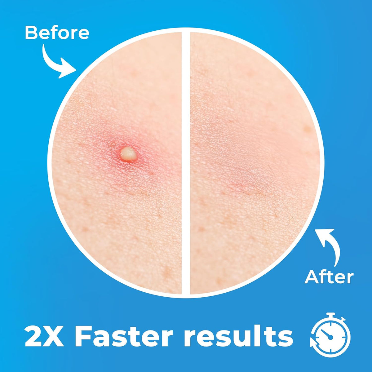 Pimple Patches for Face (500 Patches), Hydrocolloid Acne Patches with Tea Tree Oil, Pimple Patch