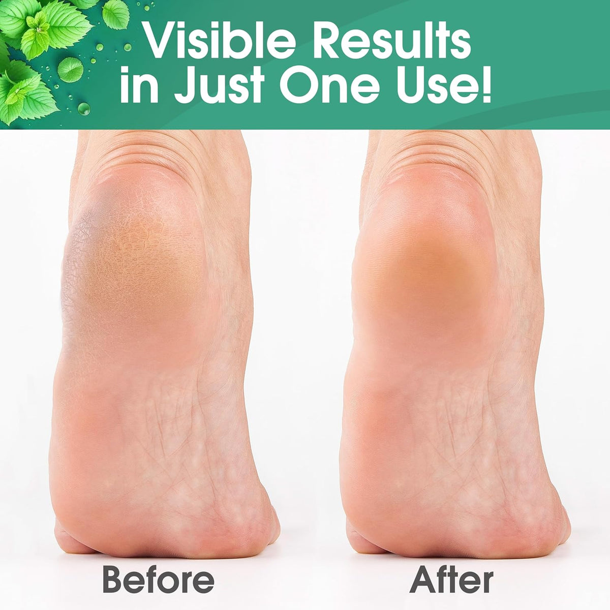 DeEnti Callus Remover for Feet, Extra Strength Foot Callus Remover Gel, 8oz Salon Grade Home