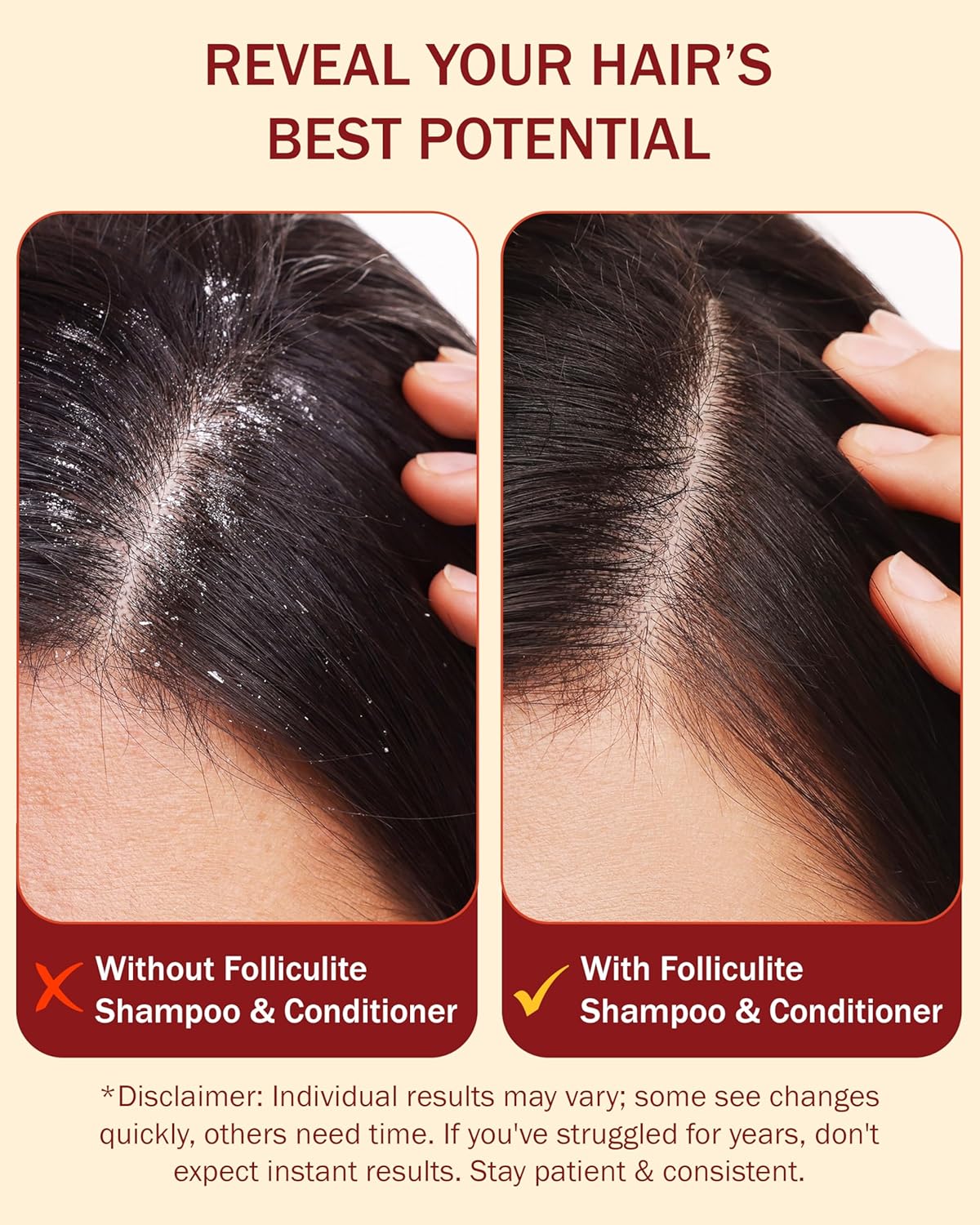 Folliculitis Treatment Shampoo and Conditioner with 3% BHA, Salicylic Acid, Aloe Vera & Tea Tree