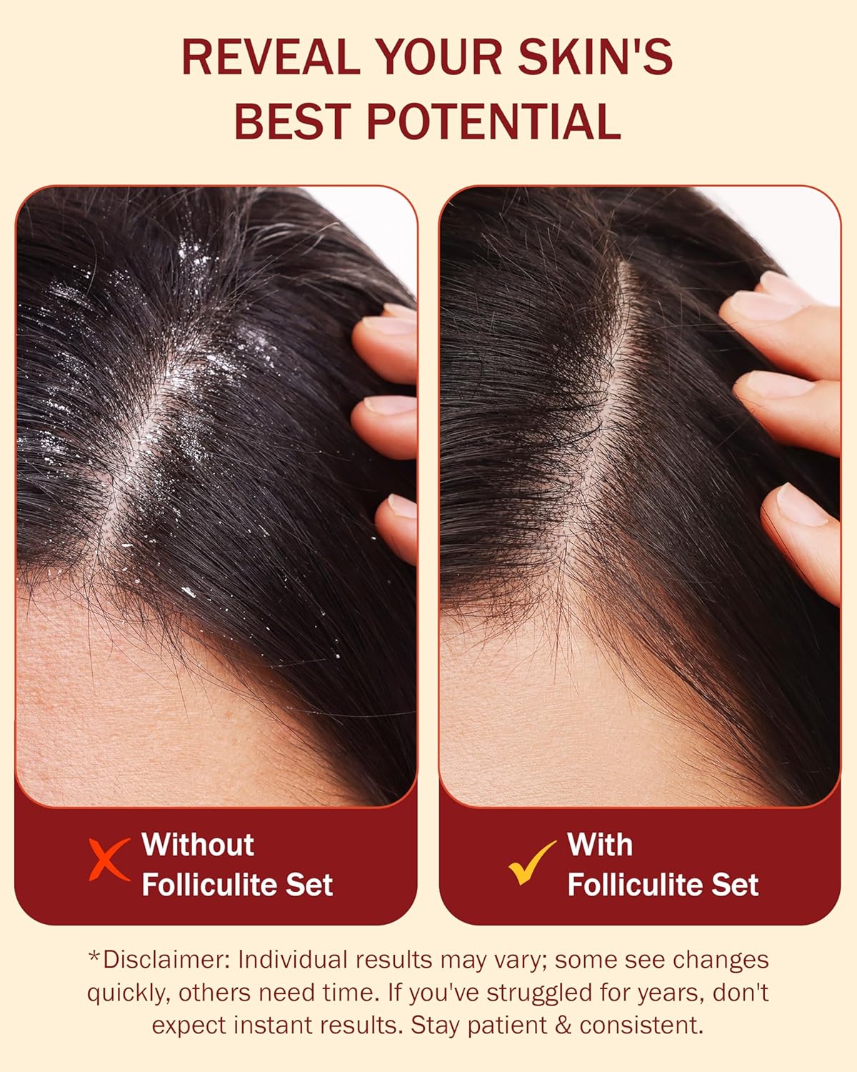 Folliculitis Treatment Shampoo with 3% BHA, Salicylic Acid, Tea Tree Oil & Chamomile Extracts