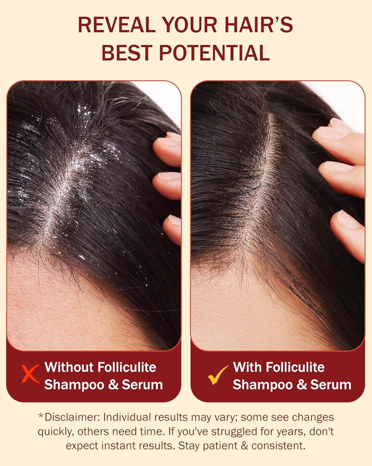 Folliculitis Treatment Shampoo & Serum with 3% BHA, Salicylic Acid, Tea Tree Oil & Chamomile